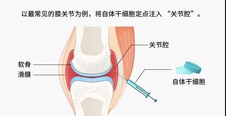 一半的致殘率！這個(gè)小毛病人人值得警惕！(圖7)